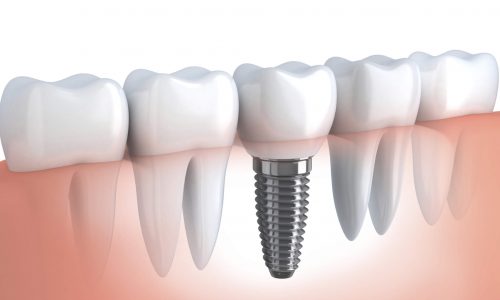 tipos-de-implante-dentario-ipanema-01